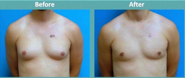 Gynecomastia